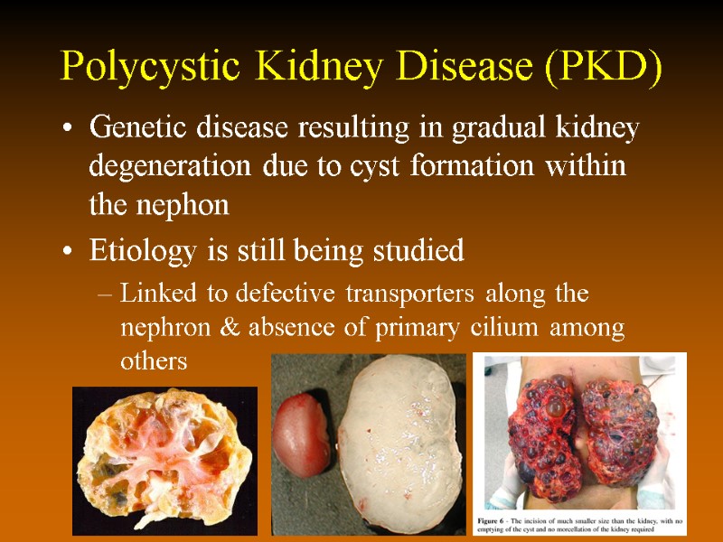 Polycystic Kidney Disease (PKD) Genetic disease resulting in gradual kidney degeneration due to cyst